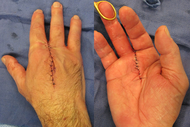 Hand after ray amputation after closure