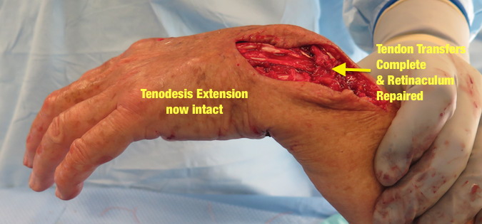 Vaughan-Jackson Syndrome Treatment by Adjacent Tendon Transfer and EIP Transfer