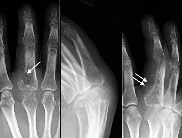 Chondrosarcoma before biopsy with disrupted cortex (arrow) and extension into soft tissues of finger. (double arrow).