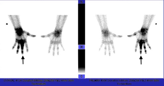 Bone scan of chondrosarcoma before biopsy with increased uptake in long finger.(arrow)