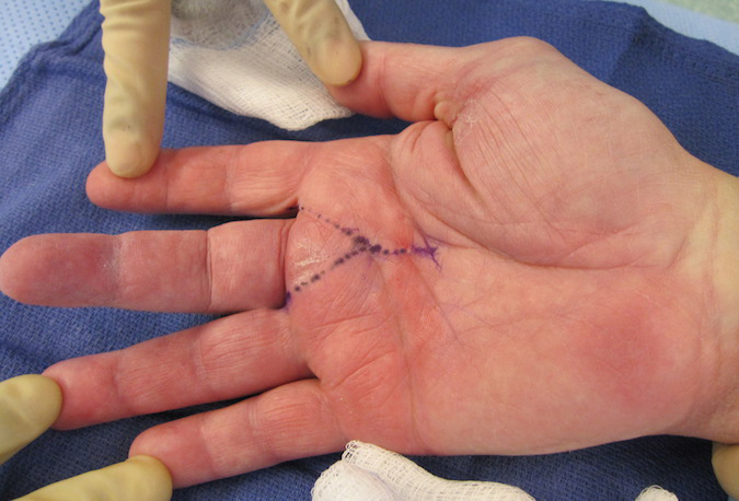 Chondrosarcoma with palmar excision marked for ray resection