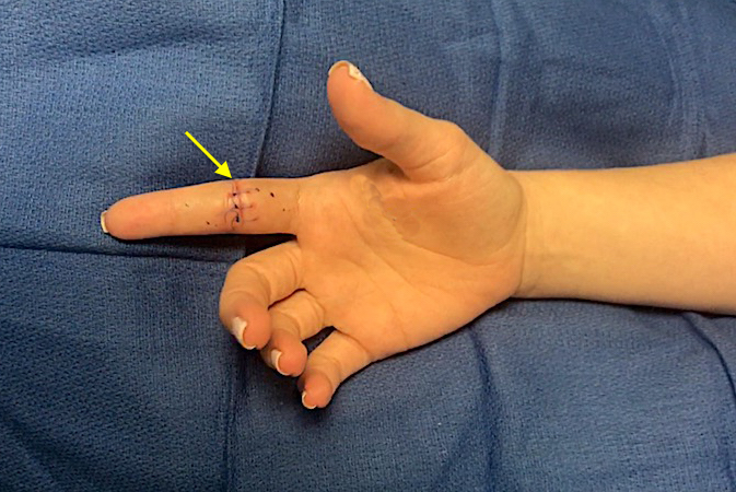 Right index finger laceration of the FDP and partial FDS laceration.