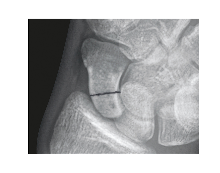 Scaphoid (Navicular) Fracture Middle 1/3 Proximal 1/3 Non- Displaced.  This fracture will be at risk for AVN.