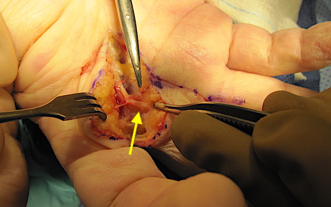 Dissection of palm for ray resection with digital nerve exposed for transection (arrow)