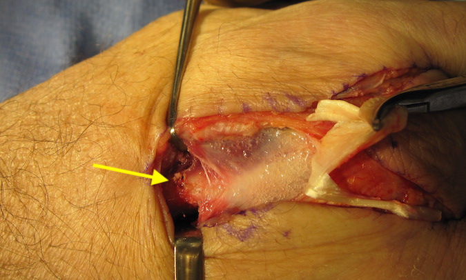 Drill holes in the metacarpal proximally prior to osteotomy (arrow)