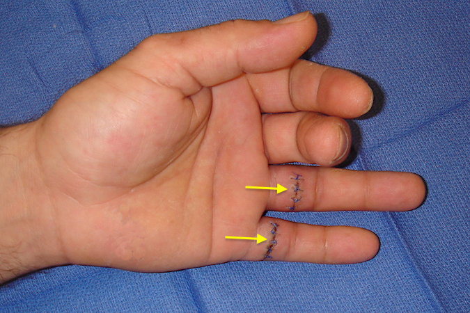 Left ring and little finger FDP and FDS tendon lacerations in "No-Man's land".  Note the loss of the normal resting finger posture.