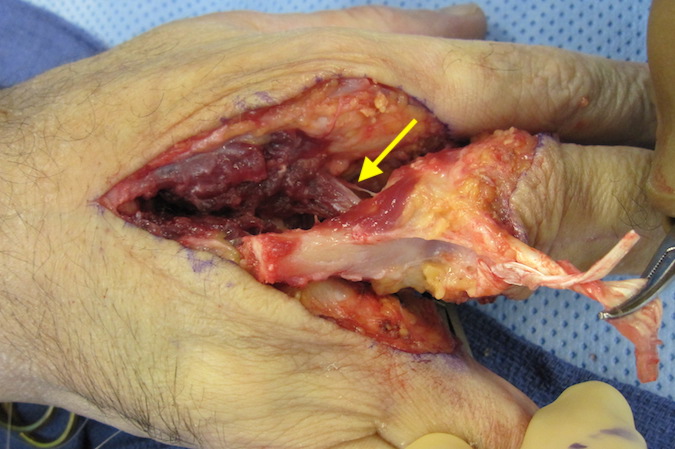 Ray amputated except for small amount of interosseous muscle and intrametacarpal ligament. (arrow)