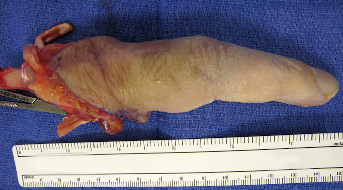 Amputated ray - Note tumor not exposed