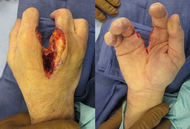Hand after ray amputation before closure