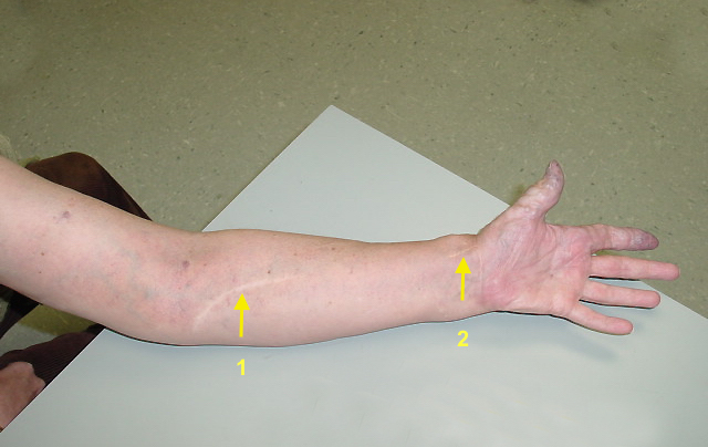 The AVM involves the entire left upper extremity. Note previous vascular surgery (1) and (2) with vascular swelling on radial wrist at (2).