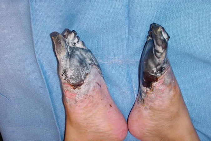 Distal foot and toe necrosis after severe frostbite injury