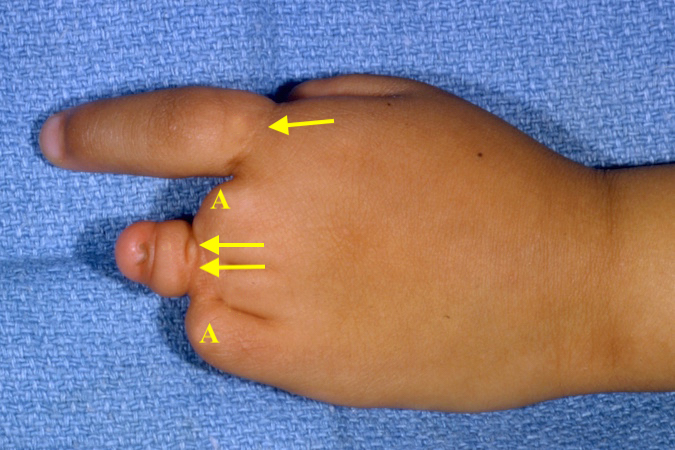 Amniotic constriction band mild (arrow), severe (double arrow) and congenital amputations (A) secondary to bands