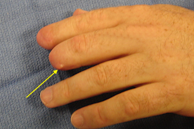 Image result for Treatment of amputated fingers
