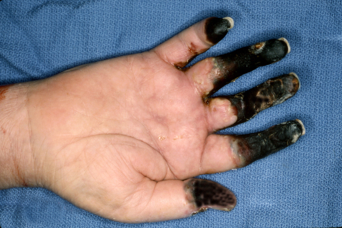Right thumb and finger necrosis after severe frostbite injury.