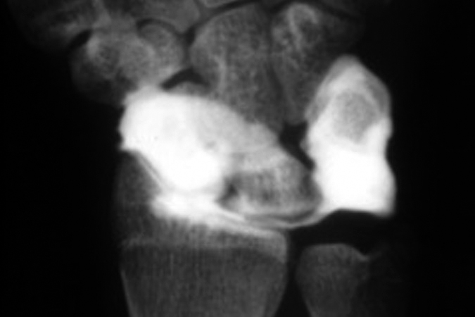 Contrast has been injected into the RC joint. The absence of contrast in the DRUJ suggests the TFCC is intact.  The classic wrist arthrogram has been replaced by MRI and MRI arthrogram imaging.