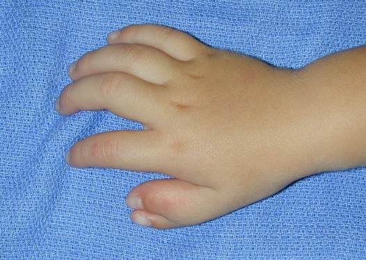 Bifid Thumb Left (Wassel IV) dorsal view