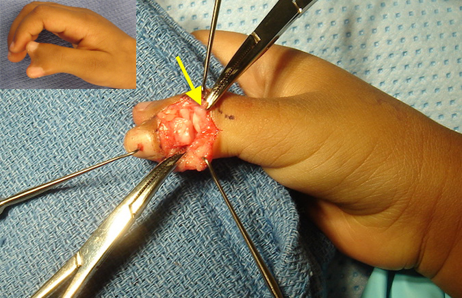 Bifid Thumb (Wassel 2) with dorsal incisions opened. Radial EPL in clamp at arrow.  This will reinforced the ulnar EPL.