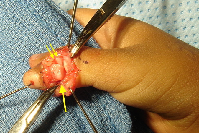Bifid Thumb (Wassel 2) with dorsal incisions opened. Radial collateral and periosteum have been dissected off the radial distal phalanx (arrow). These tissues will be attached to the radial aspect of the ulnar thumb (double arrows).