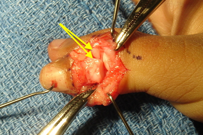 Bifid Thumb (Wassel 2) with dorsal incisions opened. Noted there are no collateral ligaments eat the junction of the two portions of the bifid thumb.