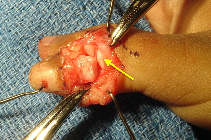 Bifid Thumb (Wassel 2) with dorsal incisions opened. The wide proximal phalanx head will be narrowed radially by cutting away cartilage without detaching the collateral ligament origin.