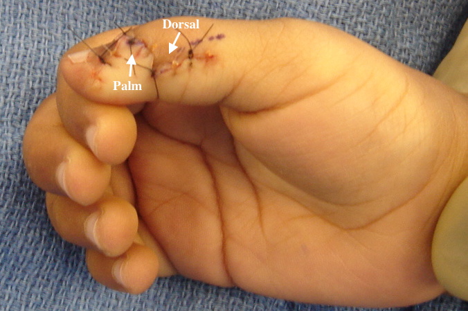 Bifid Thumb (Wassel 2) with the final curved incision. Note the use of the palmar and dorsal flaps from the amputated radial thumb.