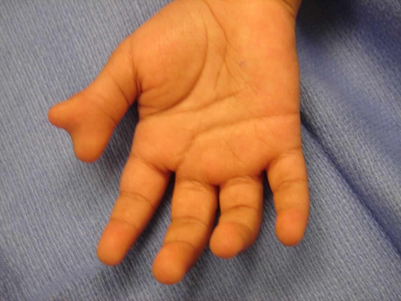 Bifid Thumb Right Palm (Wassel II)