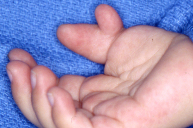 Bifid Thumb Right (Wassel IV) palmar view with small radial thumb