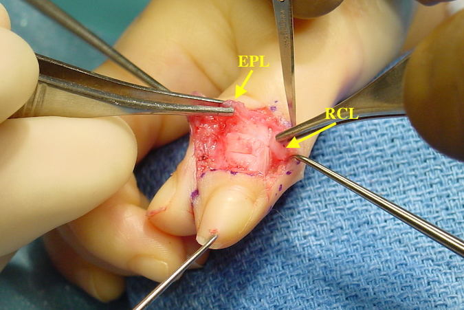 Bifid Thumb Right with preserved EPL and radial collateral to use in ulnar thumb reconstruction.