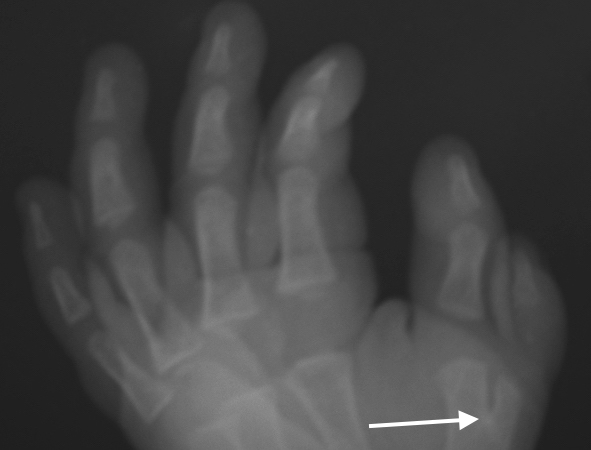 Bifid Thumb Right ( Wassel V). Note bifid first metacarpal (arrow).