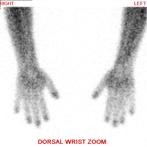 Hand and Wrist Bone Scan - Dorsal View; Normal, Blood Pool Phase of a 3 phase bone scan with no focal uptake within the osseous structure to suggest pathology