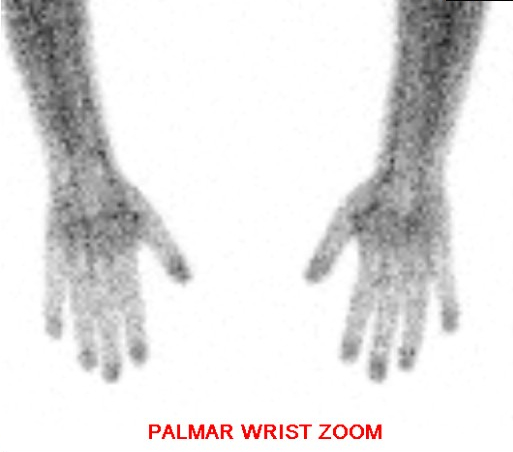 Hand and Wrist Bone Scan - Palmar View; Normal, Blood Pool Phase of a 3 phase bone scan with no focal uptake within the osseous structure to suggest pathology