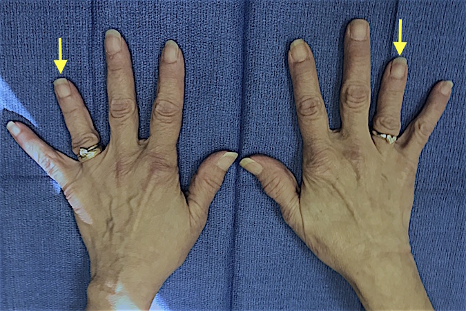 Bilateral Ring Finger Brachydactyly (arrows) secondary to shortened ring metacarpals