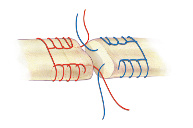 A Krachow core suture for flexor tendon repair. Usually for large tendons like the biceps but possibly useful for a FCR laceration. A 3-O or 4-O braided synthetic permanent suture is one acceptable suture choice for the the core suture.