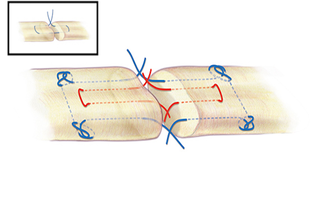 A Strickland core suture for flexor tendon repair. A 3-O or 4-O braided synthetic permanent suture is one acceptable suture choice for the the core suture.