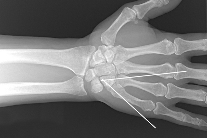 Ring and little CMC dislocations treated with closed reduction and percutaneous pinning.