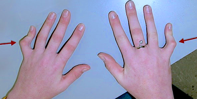Camptodactyly bilateral fifth fingers