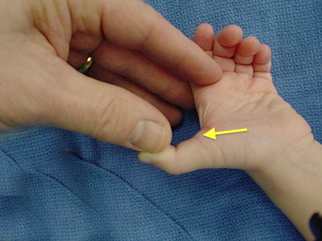 Left Pediatric Trigger Thumb