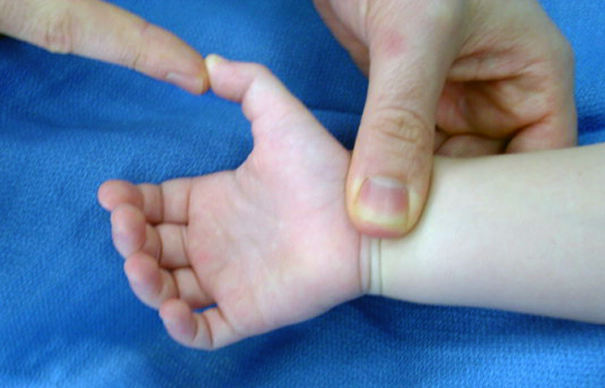 Congenital Trigger Thumb