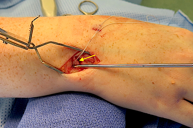A second transverse incision at the distal edge of the TFCC (arrow) has opened the RC joint. A suture anchor is being place in the ulnar head at the fovea. The anchor sutures have been passed through the volar and dorsal edges of the peripheral TFCC.  Tying these suture ends together will reattach the TFCC to the fovea.