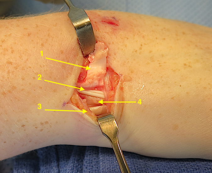 DRUJ and TFCC Exposure: 1. retinacular flap; 2 EDM tendon; 3. ECU tendon and intact edge of its sub-sheath and retinaculum; 4. DRUJ dorsal capsule.