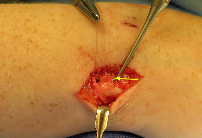 The transverse incisions in the DRUJ and RC joint capsules have been repair to the dorsal edge of the TFCC.  The retinacular flap (arrow) is used to reconstruct the ECU sheath.  This reconstructed sheath is now being sutured to the intact proximal retinaculum.