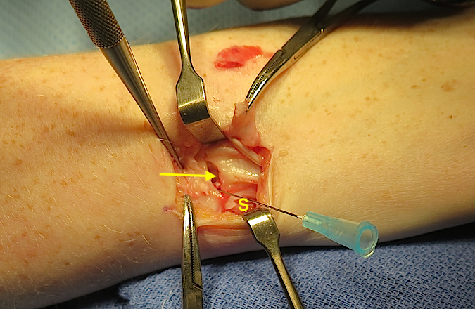 A transverse incision has been made in the DRUJ capsule.  The arrow is pointing to the proximal dorsal part of the TFCC. The needle is in the fovea. The "S' is over the ulnar styloid.