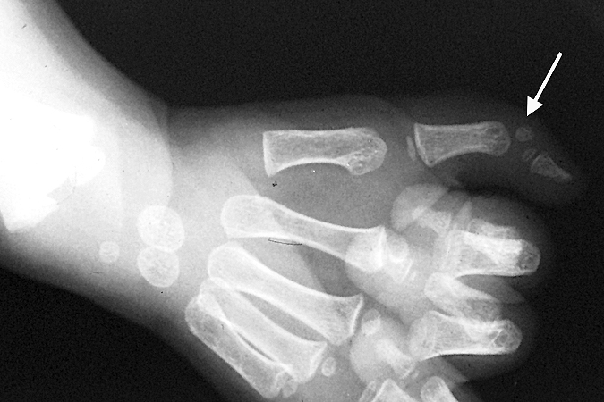 Delta phalanx (arrow) left fifth finger X-ray