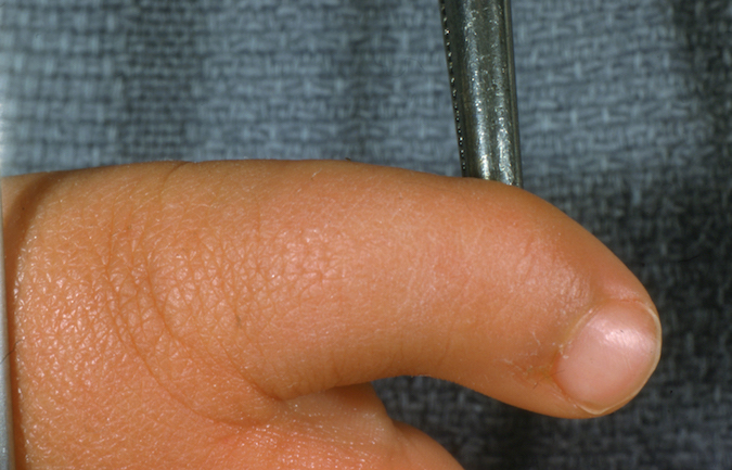 Delta phalanx left fifth finger in 2 year old infant