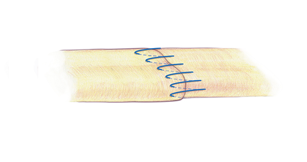 A separate second simple running  for the edge or epitenon part of the flexor tendon repair is very important. This simple running suture is appropriate suture technique for this repair . A 6-O nylon is one acceptable suture for the epitenon repair.