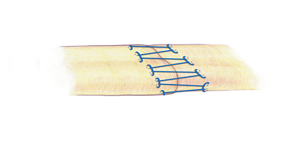 A separate second simple locking running  for the edge or epitenon part of the flexor tendon repair is very important. This simple running suture is appropriate suture technique for this repair . A 6-O nylon is one acceptable suture for the epitenon repair.