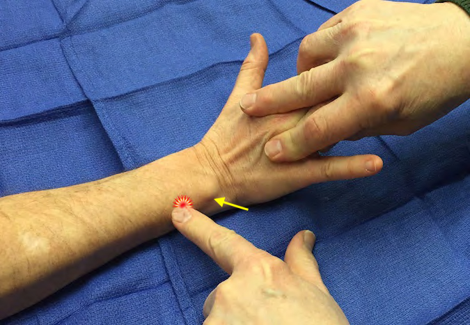 Tenderness with palpation of the ECU just proximal to the ECU groove in the ulnar head (arrow)