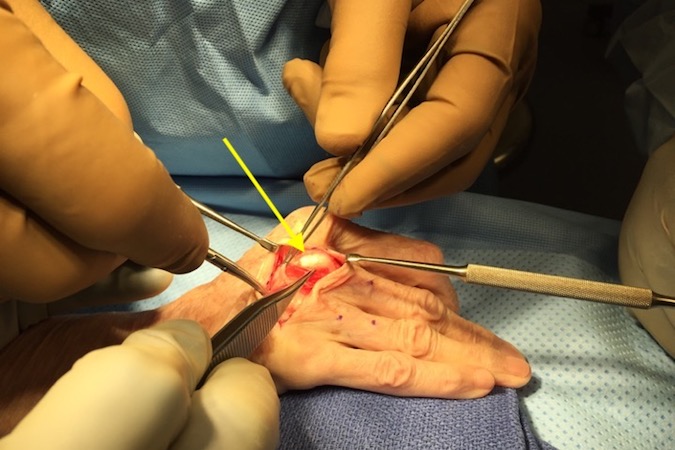 Note the surgically expose  ulnar subluxed extensor tendon (arrow)