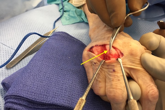 A triangular flap of capsule which is attached to the dorsal base of the proximal phalanx has been pulled through a central slip in the extensor tendon (arrow). The flap is held in place with the clamp until it is securely sutured to the extensor tendon.