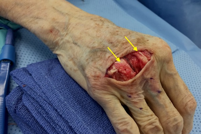 Both the long and ring extensor tendons have been centralized with the capsular flap technique (arrows). The junctura to the little finger has been repaired without tension on the centralization off the ring extensor.
